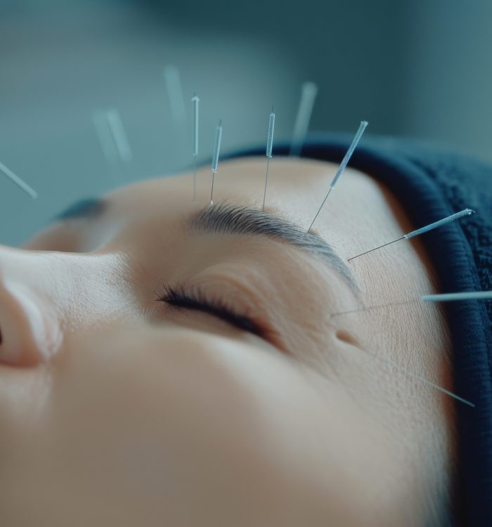 A person receives acupuncture treatment with fine needles carefully placed on their forehead, promoting relaxation and healing in a serene wellness environment.