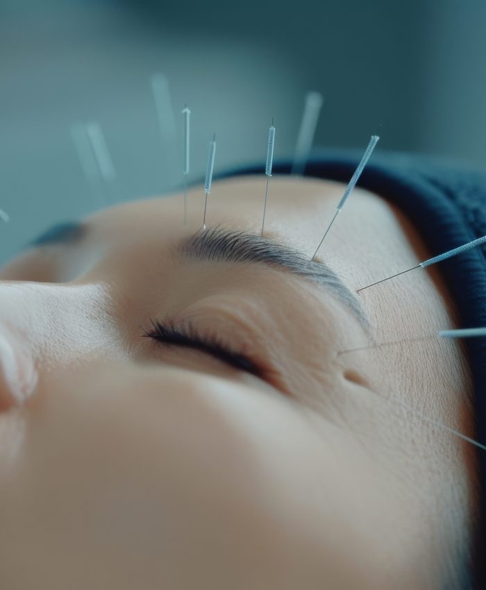 A person receives acupuncture treatment with fine needles carefully placed on their forehead, promoting relaxation and healing in a serene wellness environment.