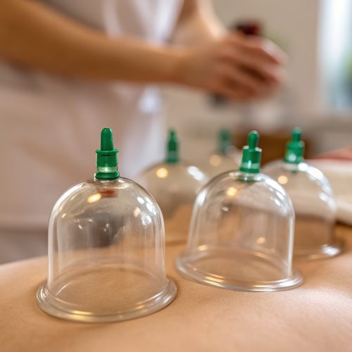 Close-up photograph of clear cupping therapy cups with green tops placed on the back of a patient lying on a table with a therapist in the background.