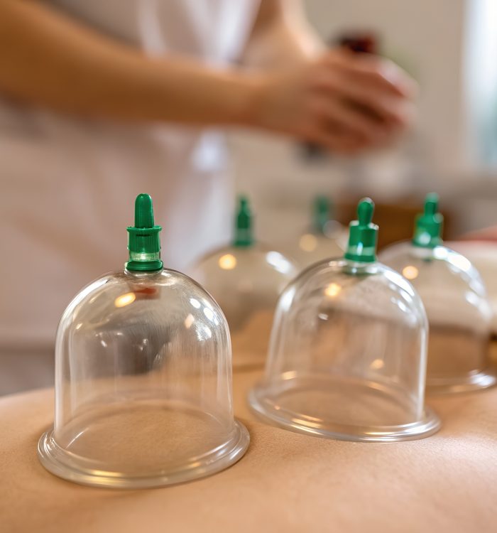 Close-up photograph of clear cupping therapy cups with green tops placed on the back of a patient lying on a table with a therapist in the background.