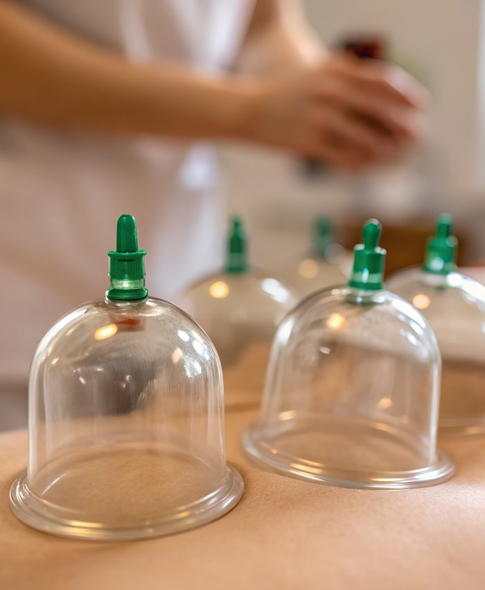 Close-up photograph of clear cupping therapy cups with green tops placed on the back of a patient lying on a table with a therapist in the background.