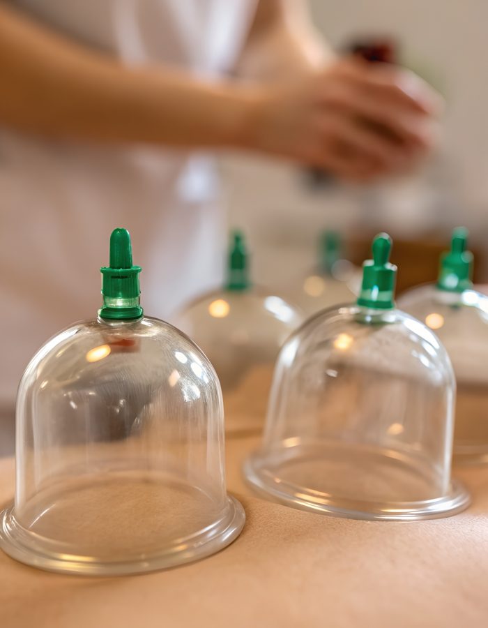 Close-up photograph of clear cupping therapy cups with green tops placed on the back of a patient lying on a table with a therapist in the background.
